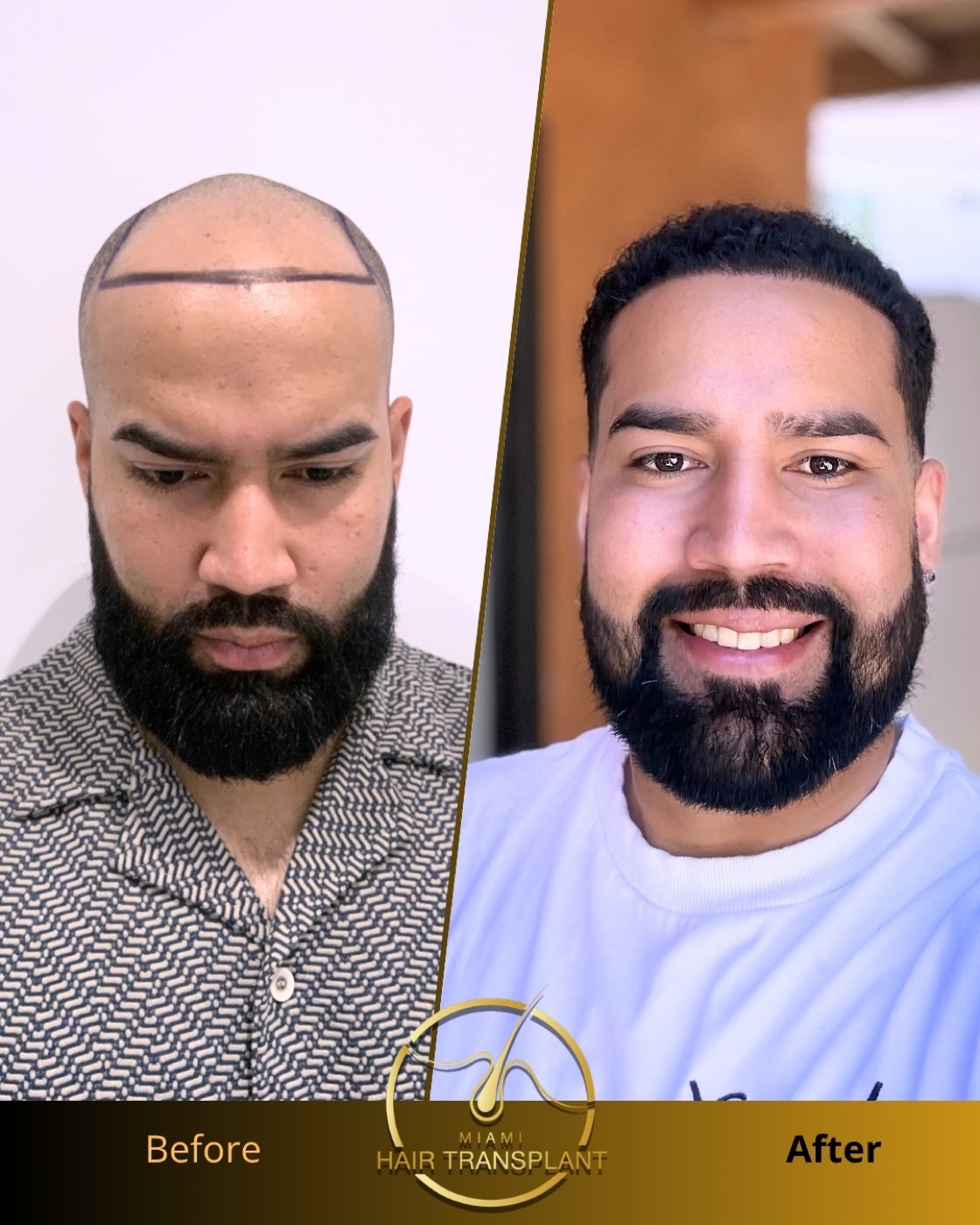 Before and after hair transplant result at Miami Hair Transplant, case 4