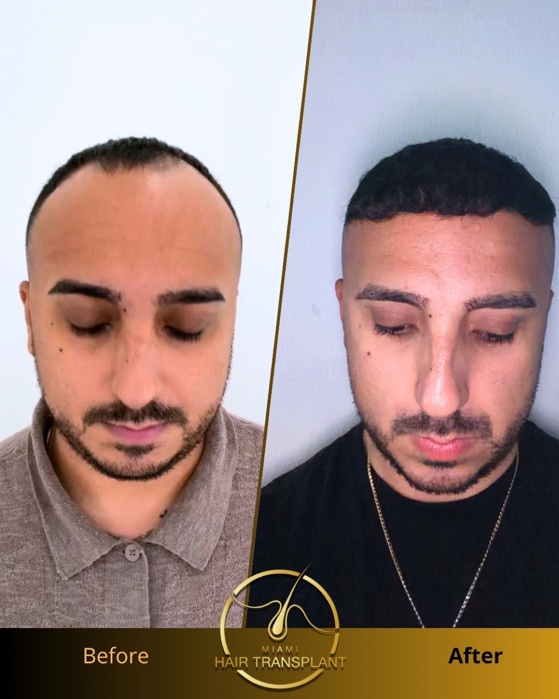 Before and after hair transplant result at Miami Hair Transplant, case 5