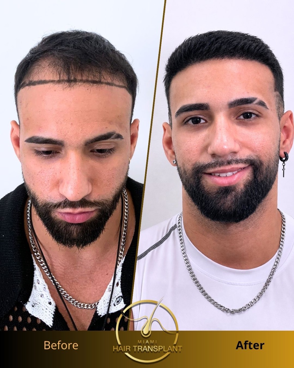 Before and after hair transplant result at Miami Hair Transplant, case 6