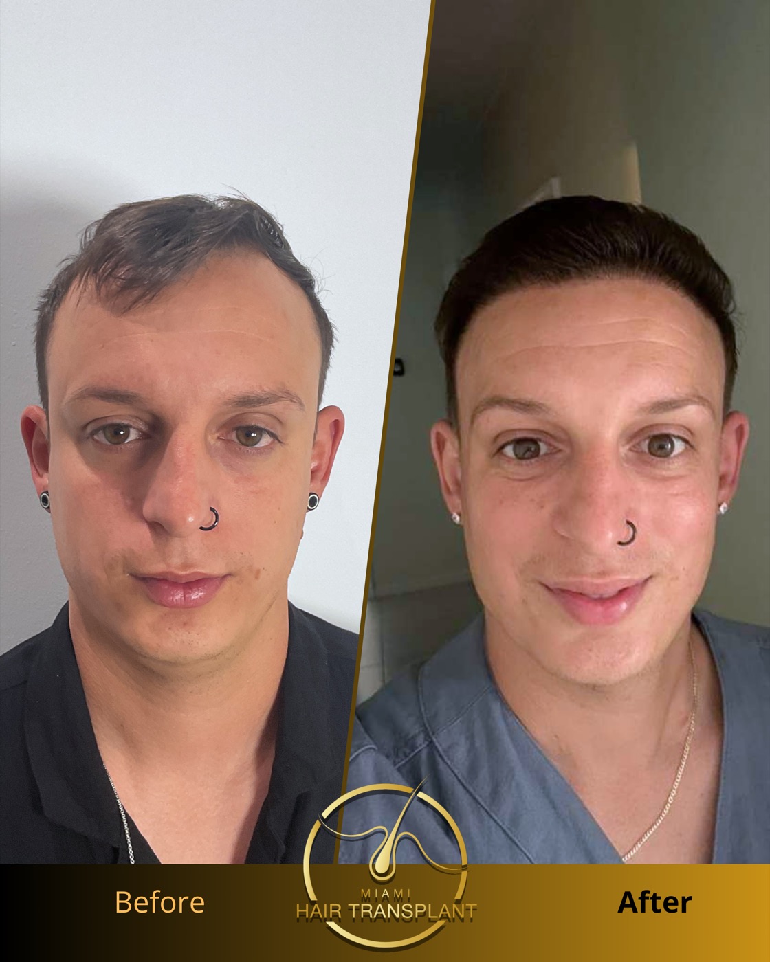 Before and after hair transplant result at Miami Hair Transplant, case 7