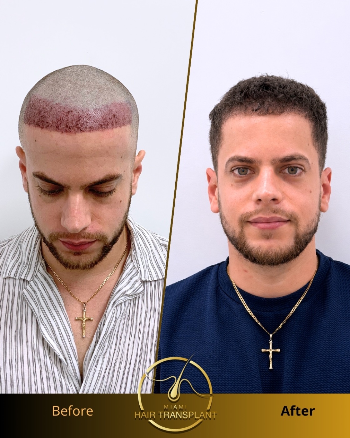 Before and after hair transplant result at Miami Hair Transplant, case 8