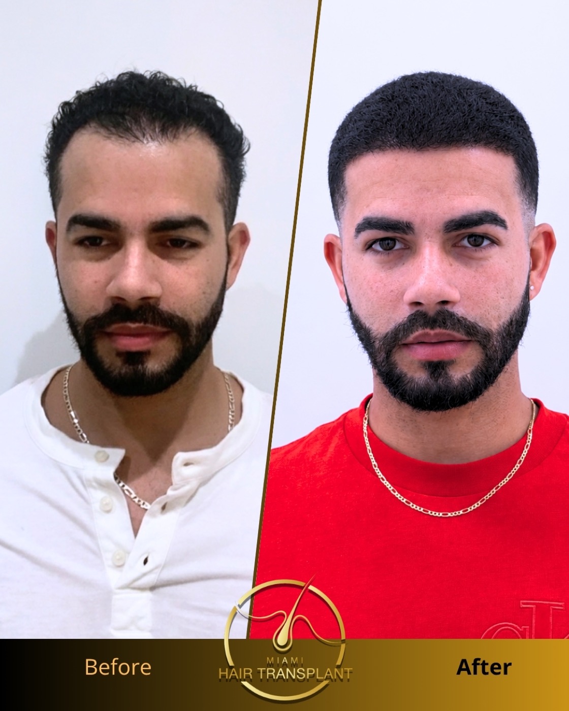 Before and after hair transplant result at Miami Hair Transplant, case 10