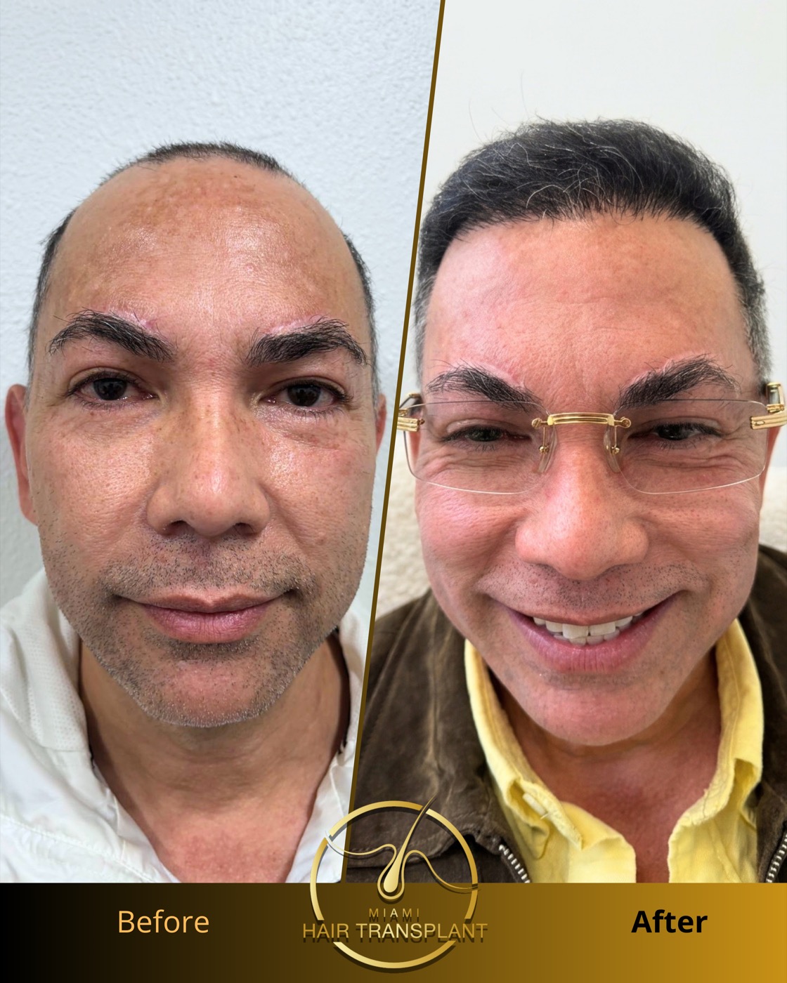 Before and after hair transplant result at Miami Hair Transplant, case 11