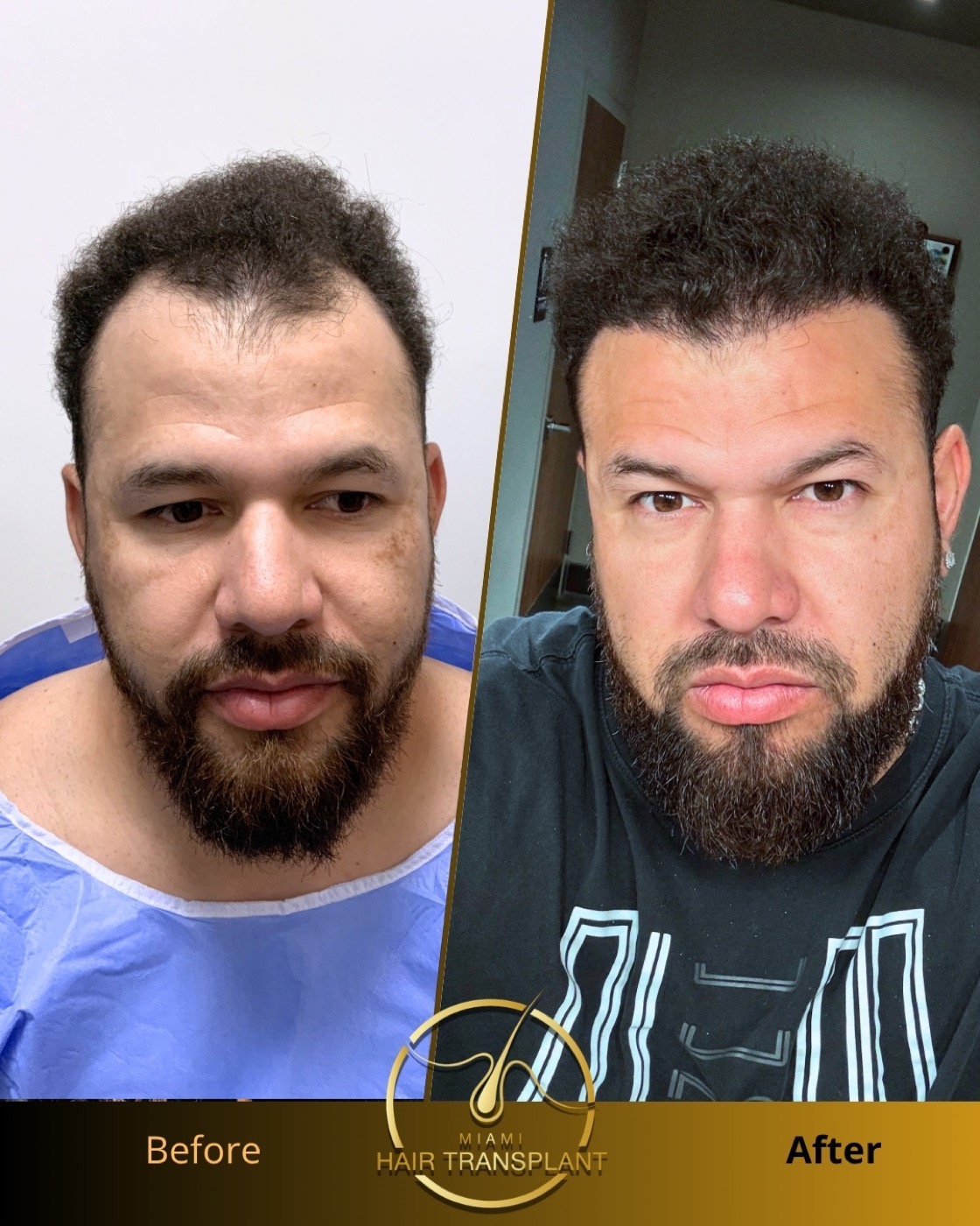 Before and after hair transplant result at Miami Hair Transplant, case 12