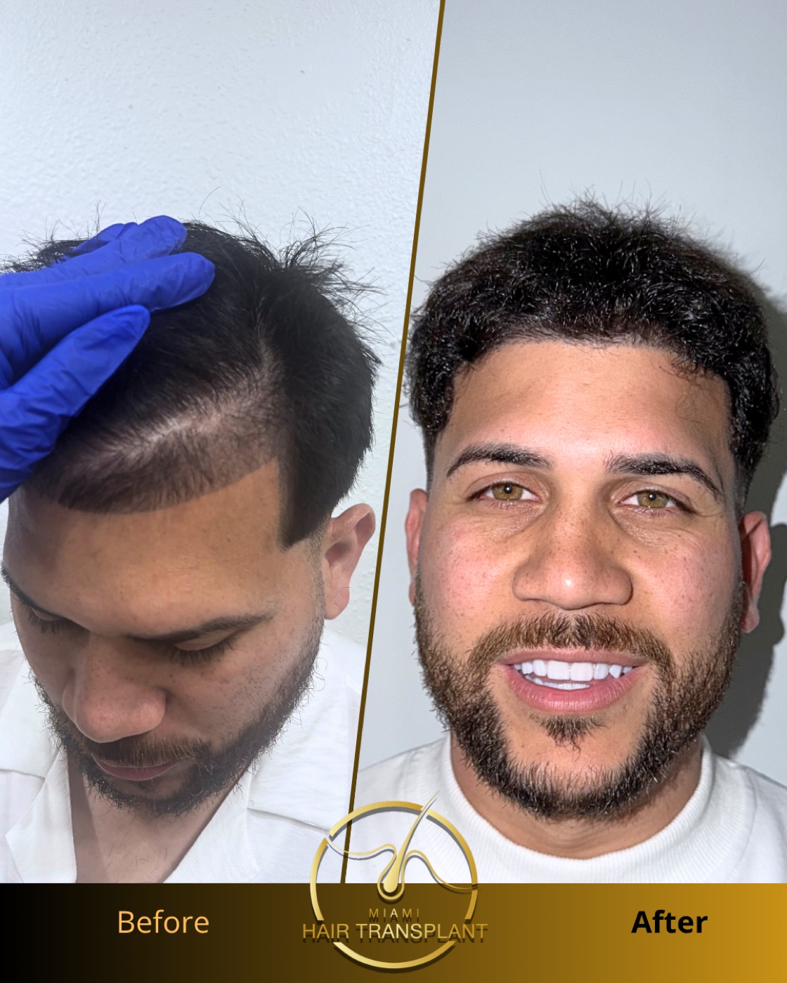 Before and after hair transplant result at Miami Hair Transplant, case 13