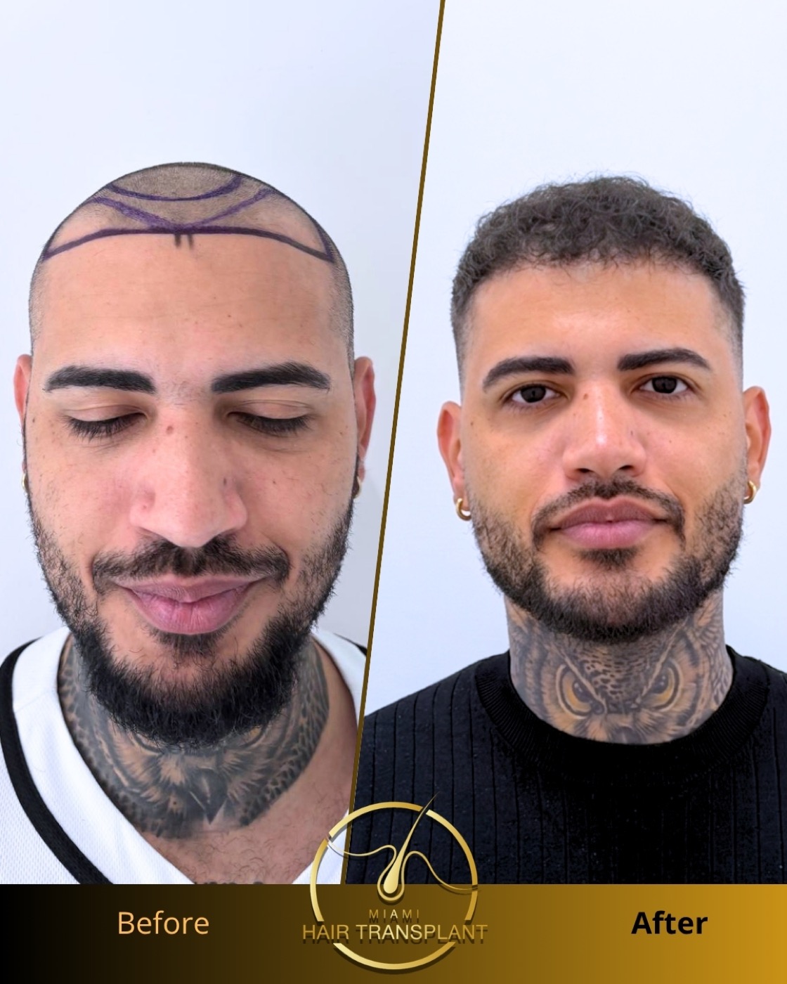 Before and after hair transplant result at Miami Hair Transplant, case 14