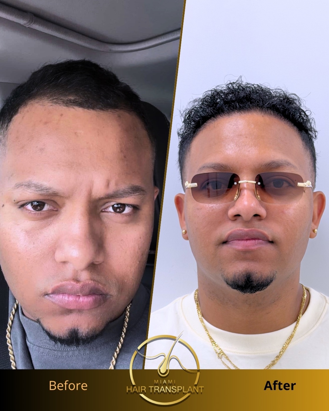 Before and after: textured hair FUE transplant, nine months post-op