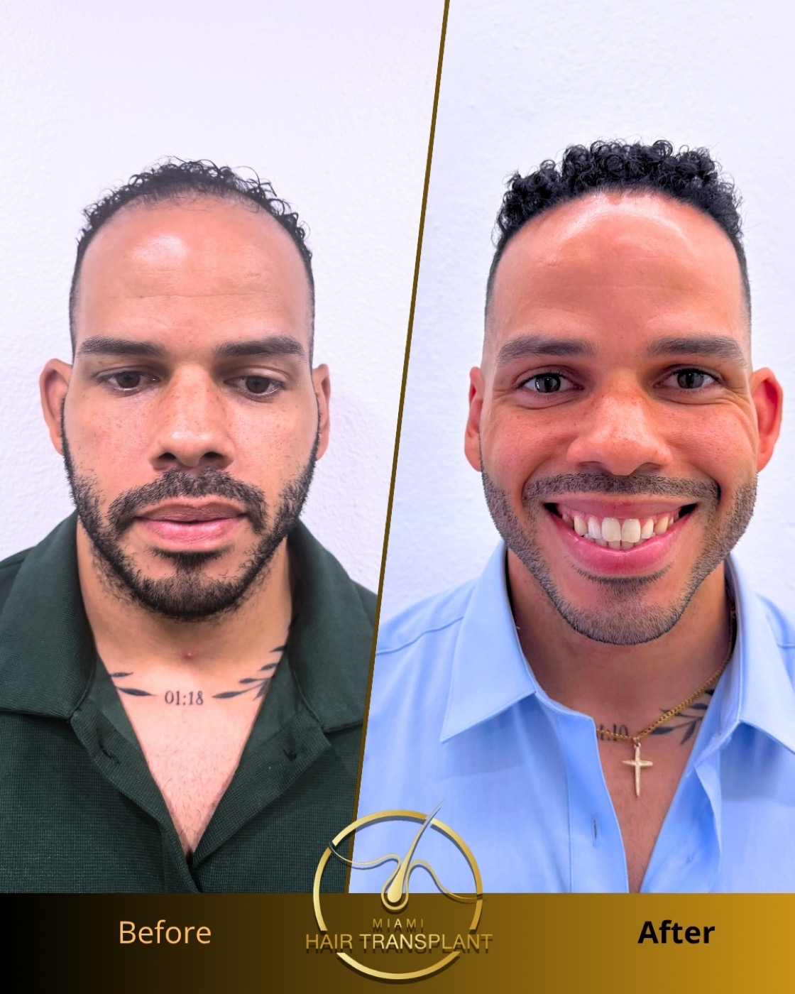 Before and after: frontal-zone FUE restoration, nine months post-op