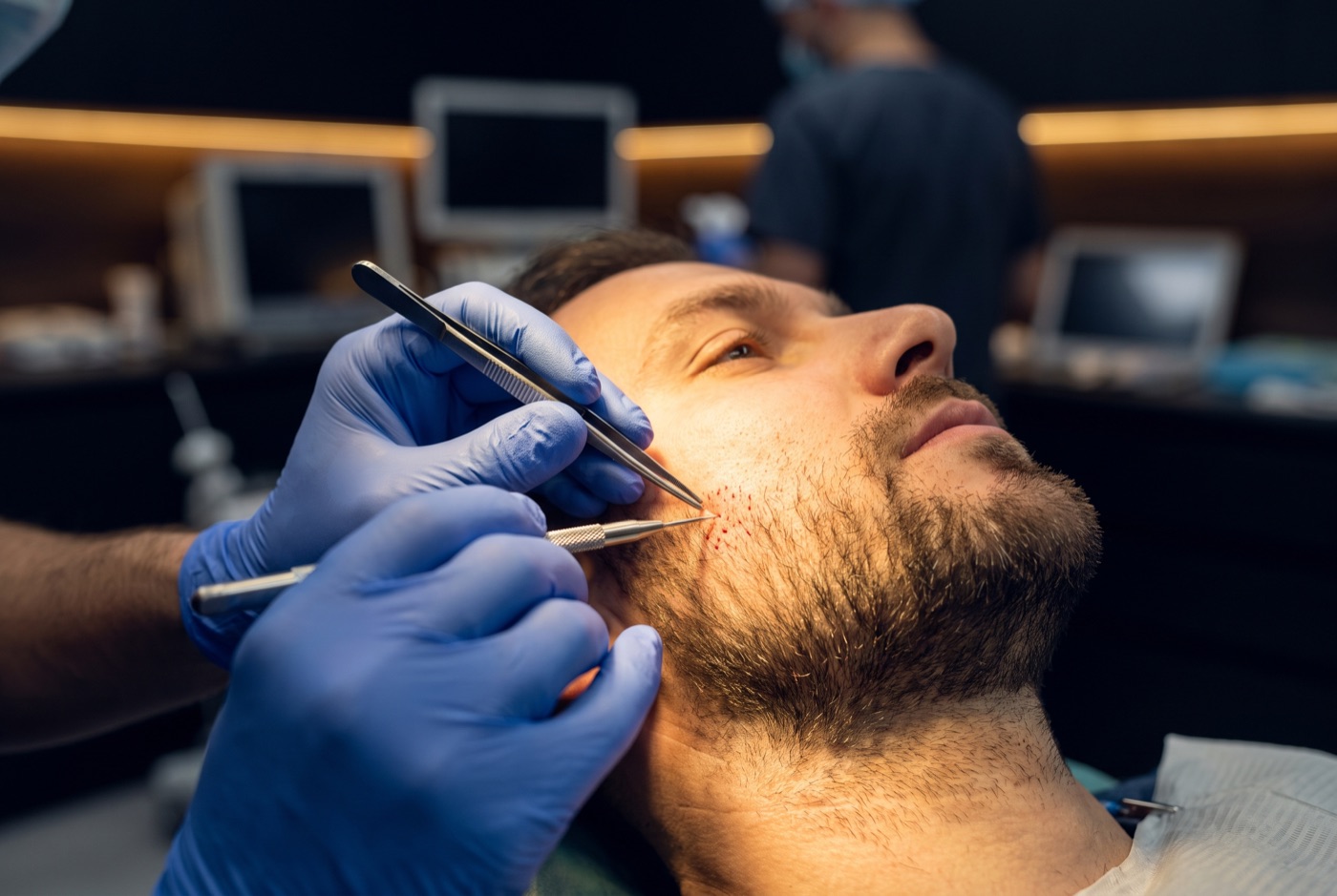 Follicles being implanted into the jawline during a beard transplant