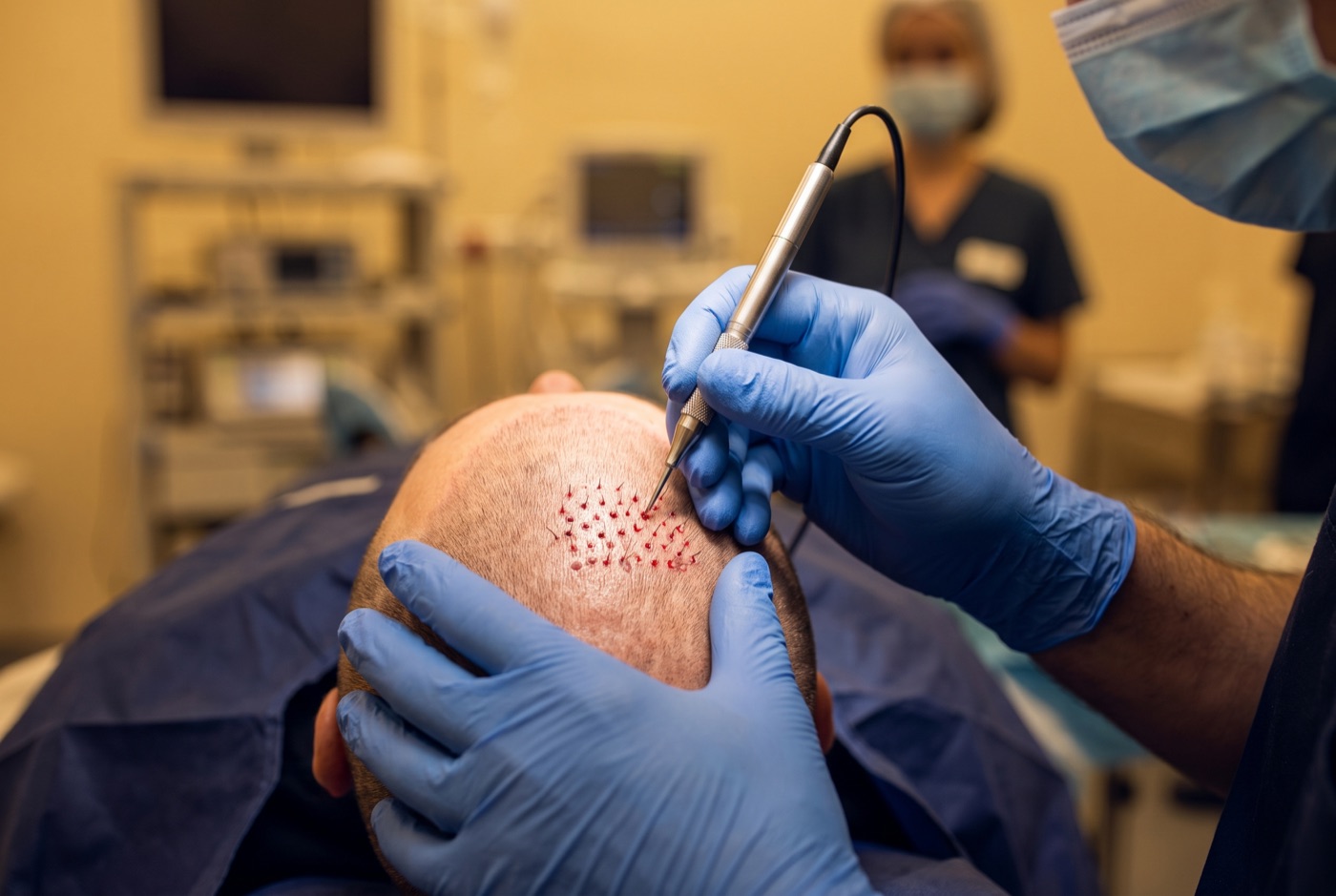 Surgeon performing FUE follicle extraction on a donor area