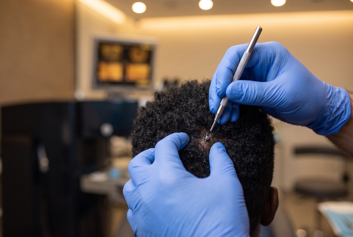 FUE extraction on afro-textured curly hair