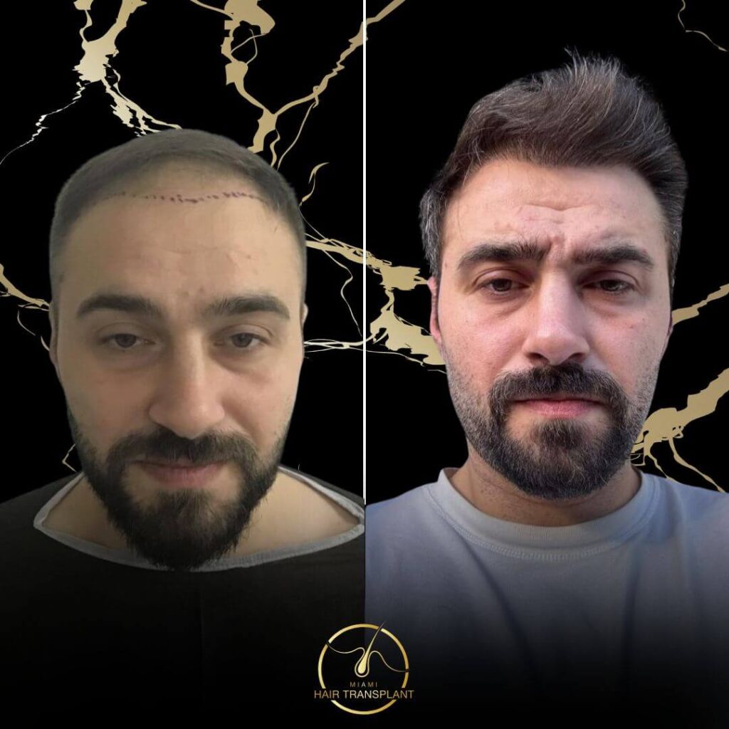 Miami Hair Transplant - Before and After